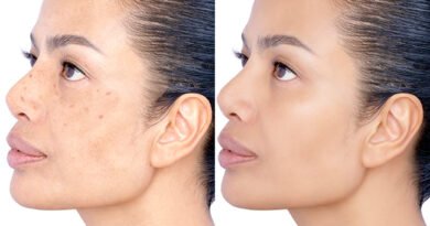 The-Symptoms-Prevention,-And-Treatment-Of-Melasma