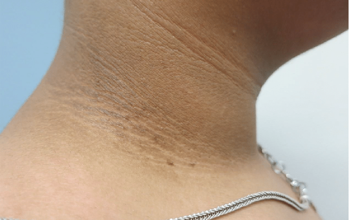 Acanthosis-nigricans