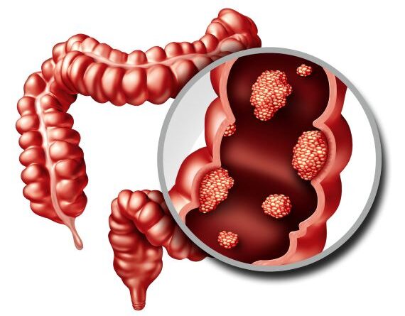 Why-are-young-people-more-prone-to-colon-cancer-in-india