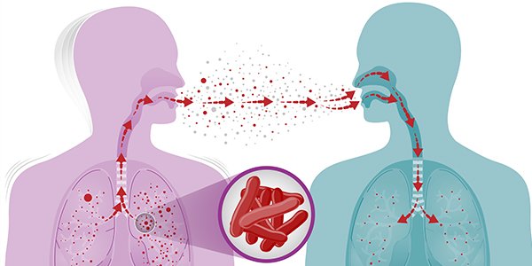 Can-TB-occur-even-without-cough?