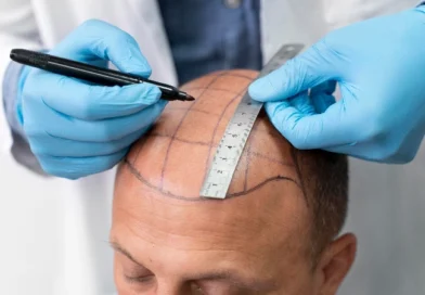 hair-transplant