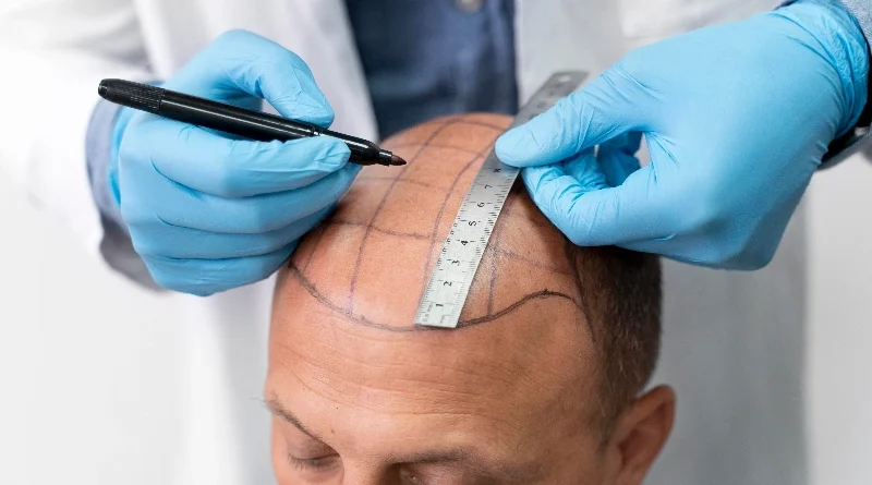 hair-transplant