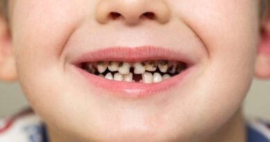 children-have-cavities-in-their-teeth