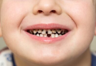 children-have-cavities-in-their-teeth