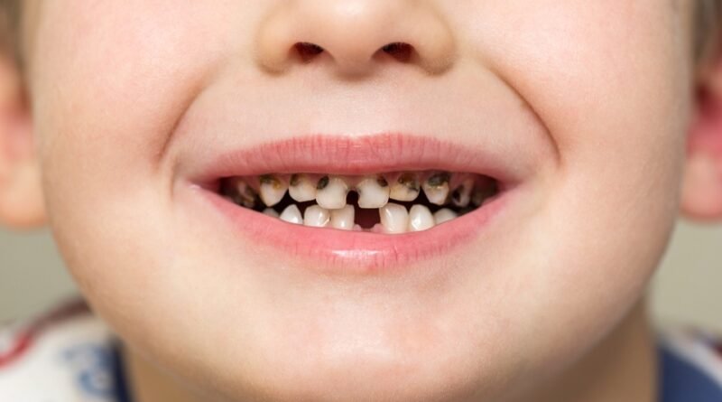 children-have-cavities-in-their-teeth