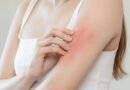 Skin-allergy