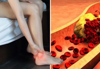 signs-of-increasing-cholesterol