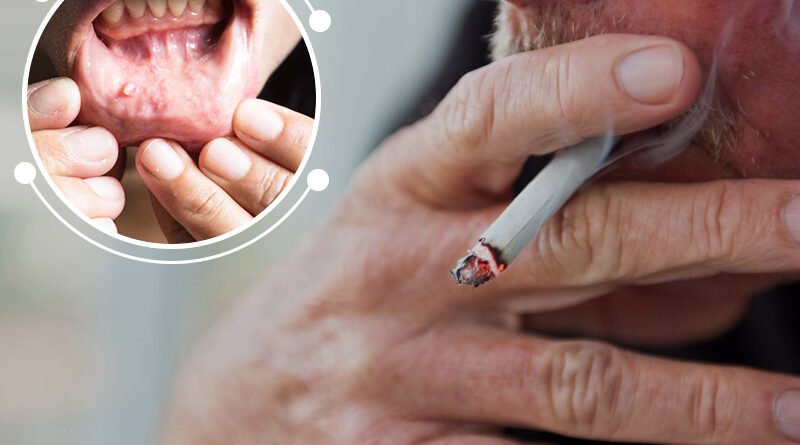 smoking-cigarettes-can-also-cause-lip-cancer