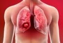 Why-are-non-smokers-also-becoming-victims-of-lung-cancer