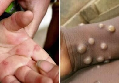 new-variant-of-monkeypox