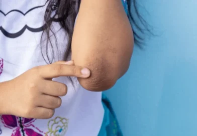 This is a magical cream to get rid of black elbows