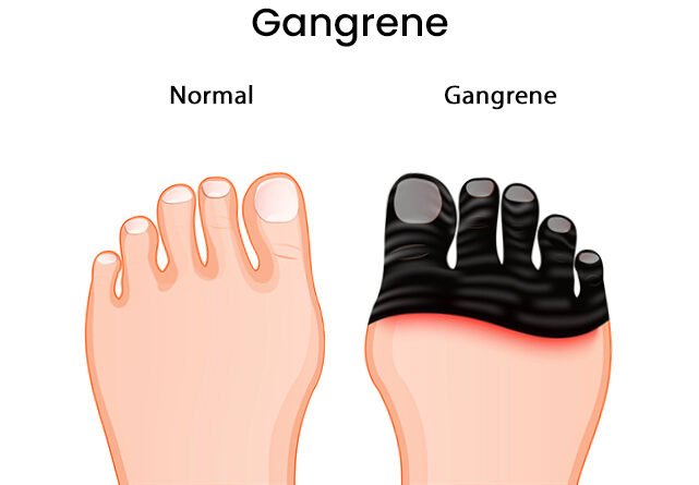 gangrene-symptoms-causes