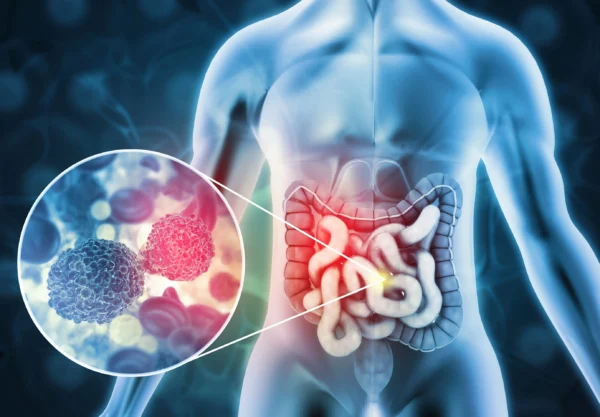 the-silent-signs-of-colorectal-cancer