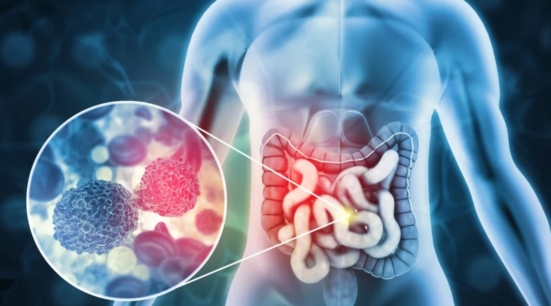 the-silent-signs-of-colorectal-cancer