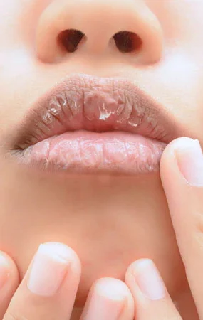 dry-cracked-and-dark-lipswhat-do-they-mean-learn-more-about-it